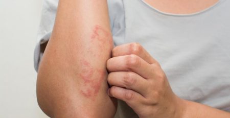 eczema-–-i-stopped-itching-and-started-healing