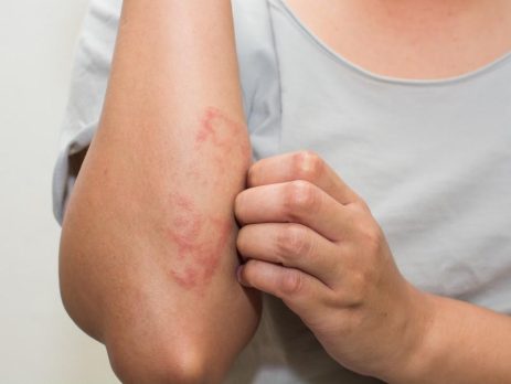 eczema-–-i-stopped-itching-and-started-healing