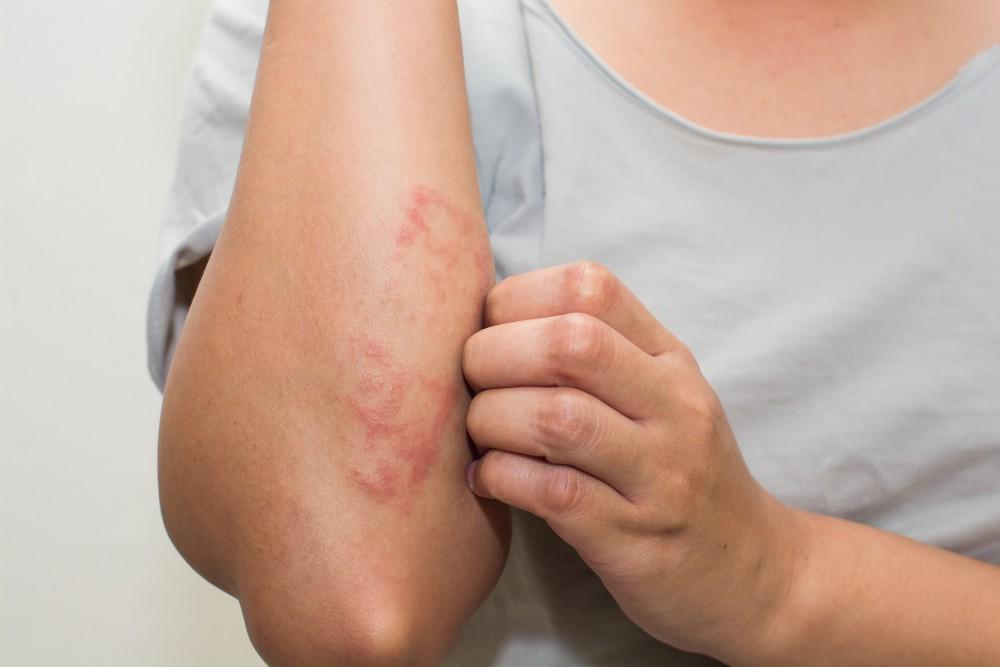 eczema-–-i-stopped-itching-and-started-healing