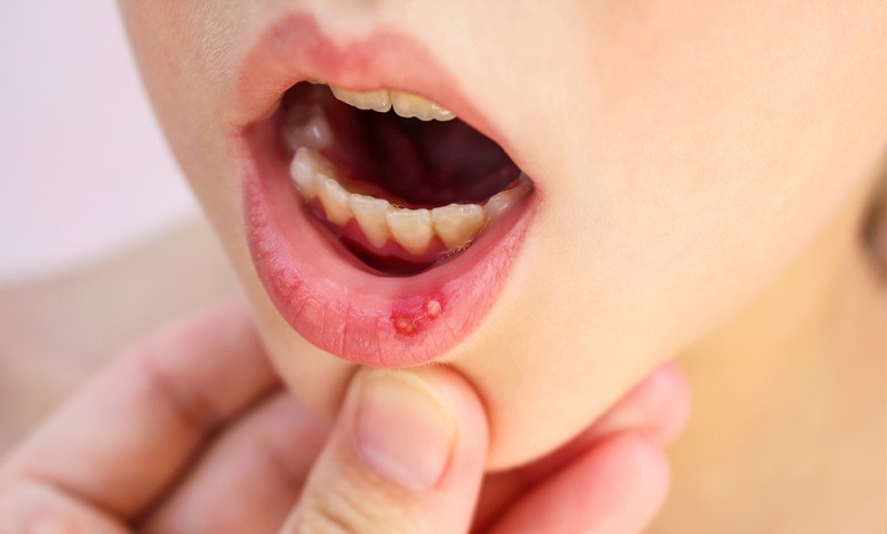 mouth-ulcer