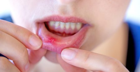 mouth-ulcers-and-dizziness