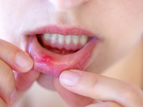 mouth-ulcers-and-dizziness