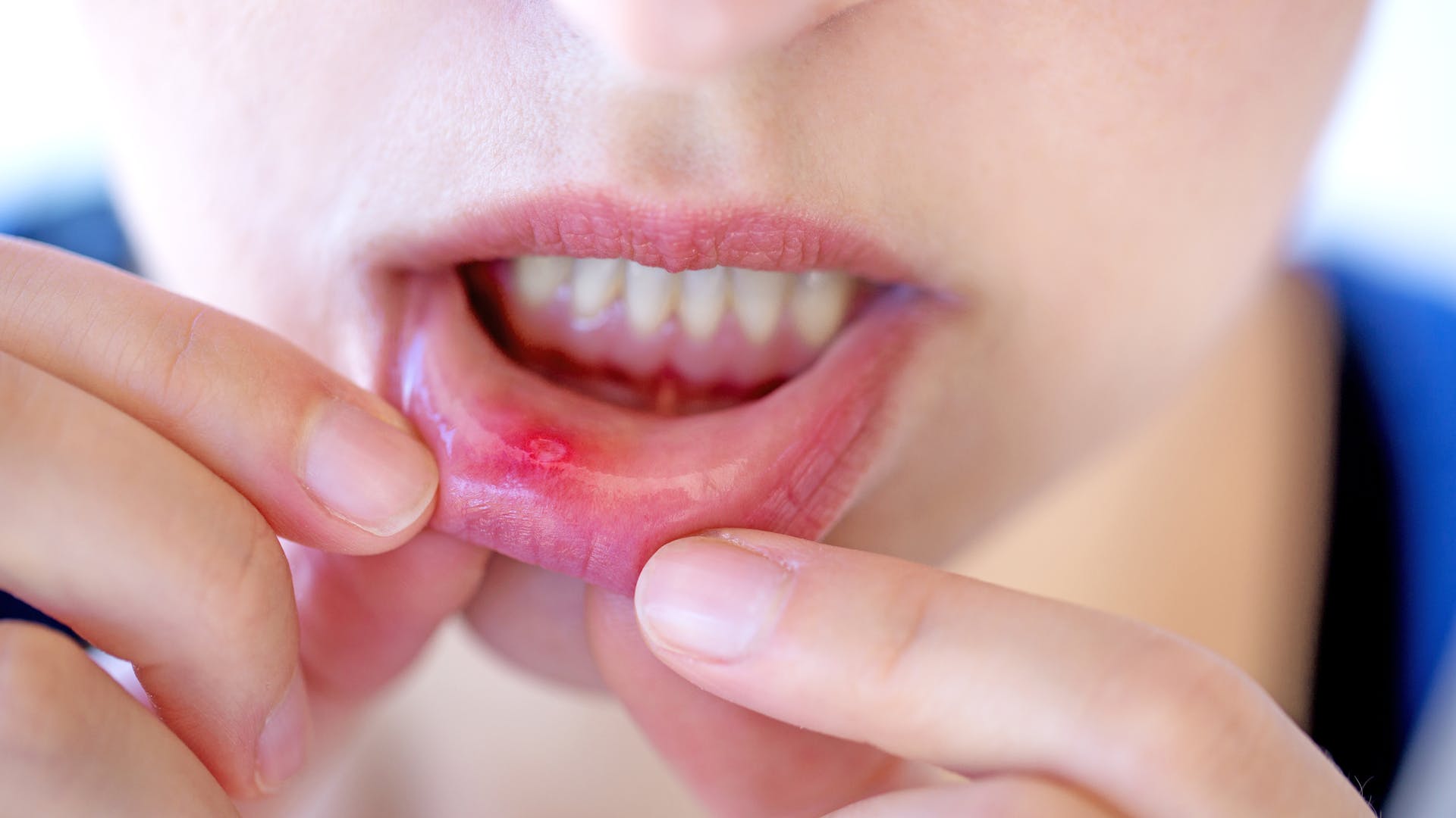 mouth-ulcers-and-dizziness