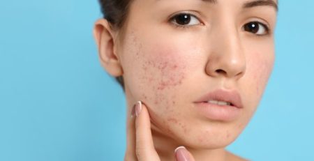 skin-issues-antibiotics-and-roaccutane