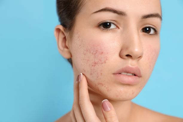 skin-issues-antibiotics-and-roaccutane