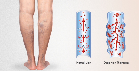 varicose-vein-thrombosis