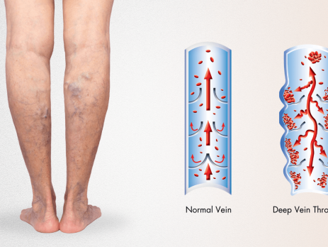 varicose-vein-thrombosis