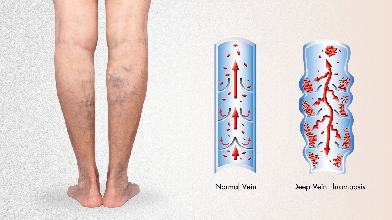 varicose-vein-thrombosis